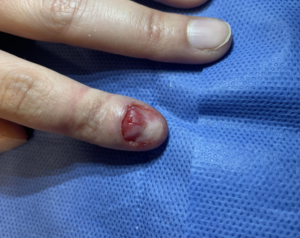 Tumor Unguial, paciente en DermaWise Clinica Dermatologica CDMX