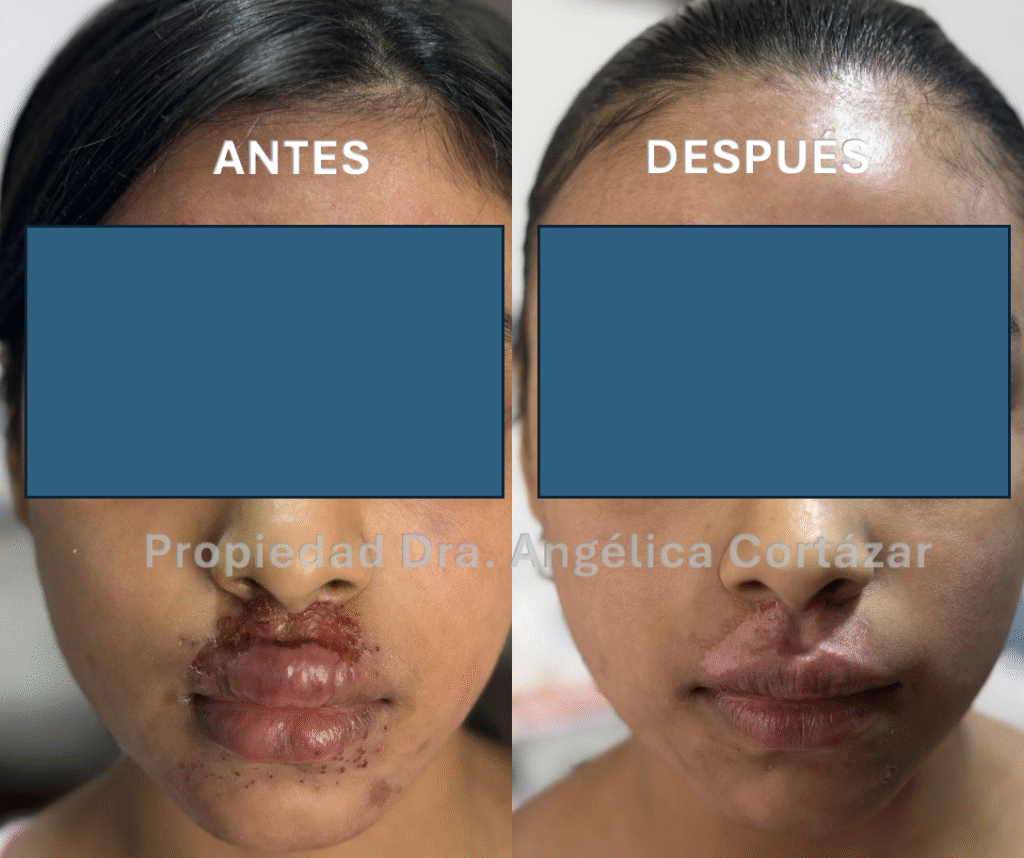 Dermatitis atómica severa: Antes y después