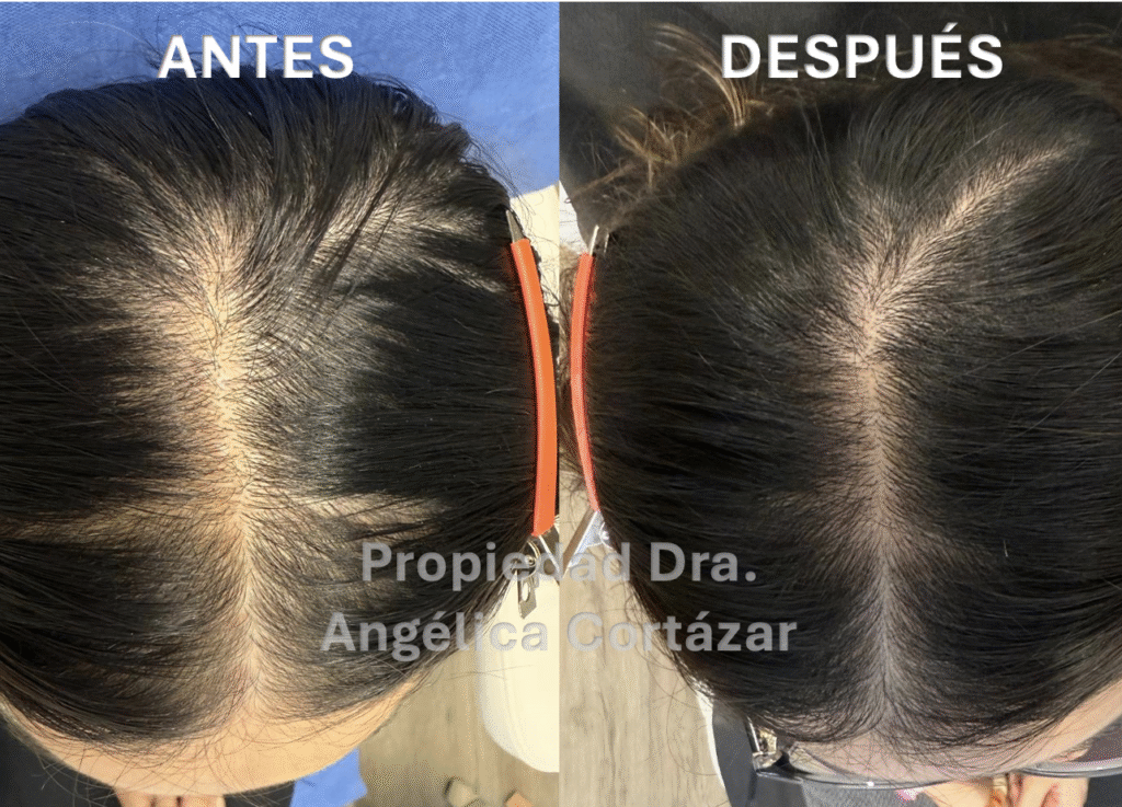 Antes y después de paciente con Alopecia Femenina