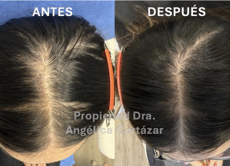 Antes y después de paciente con Alopecia Femenina
