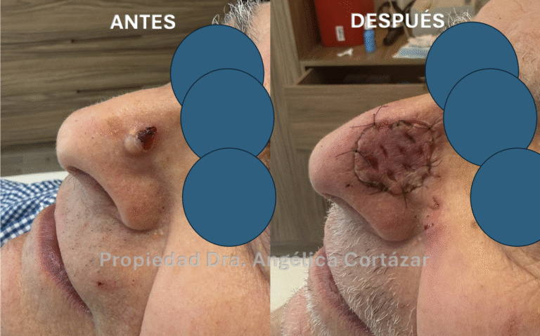 Cancer de Piel Carcinoma injerto