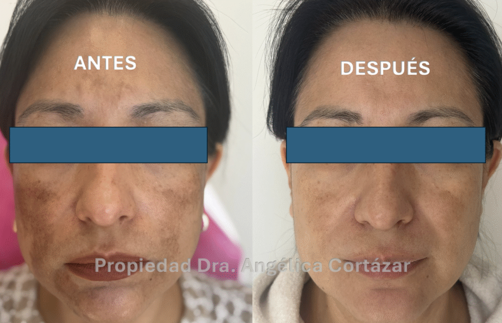 Paciente con melasma tratado por Dermatólogo CDMX en DermaWise