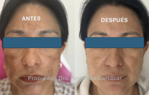 Paciente con melasma tratado por Dermatólogo CDMX en DermaWise