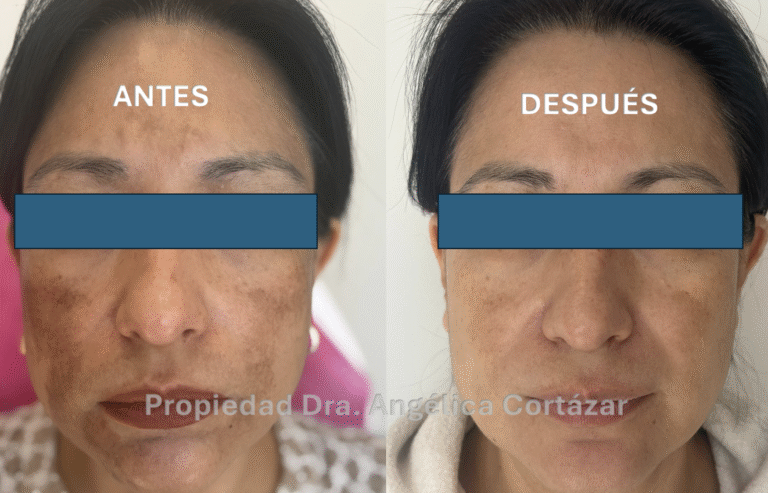 Paciente con melasma tratado por Dermatólogo CDMX en DermaWise