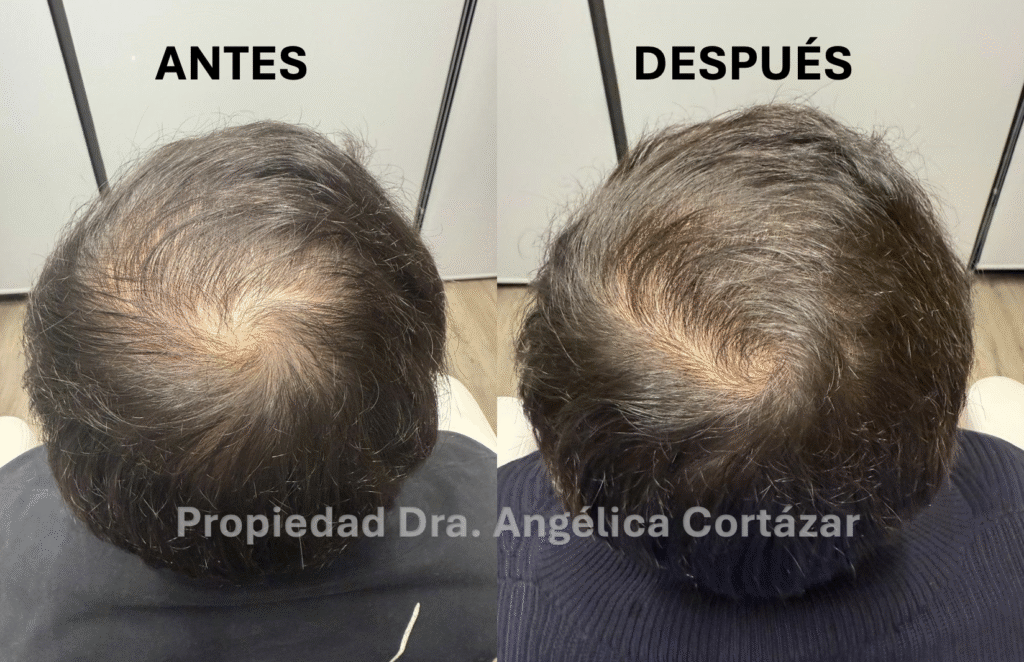 Tratamiento para Alopecia: Antes y Despues