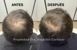 Tratamiento para Alopecia: Antes y Despues