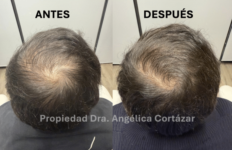 Tratamiento para Alopecia: Antes y Despues