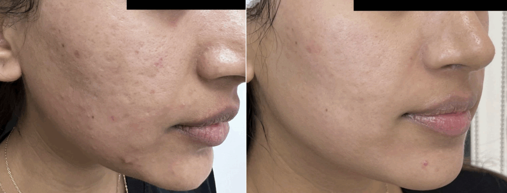Antes y después de paciente 6 semanas despues de realizar 2 sesiones con Cutera Secret RF