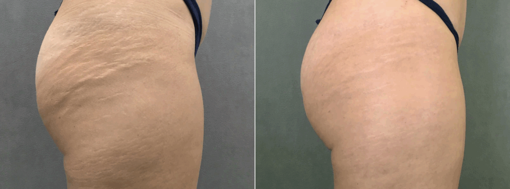 Antes y despues de aplicar Radiofrecuencia fraccionada con microagujas tres meses despues de la ultima aplicación.