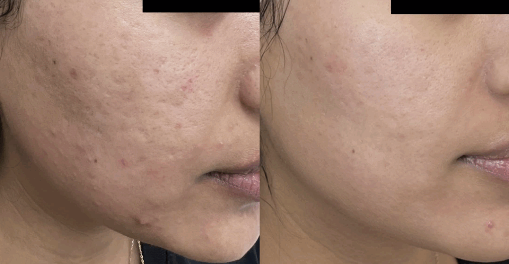 Antes y despues - Radiofrecuencia fraccionada con microagujas en CDMX