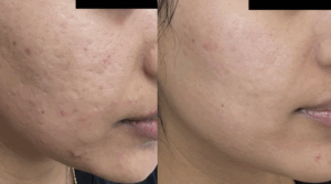 Antes y despues - Radiofrecuencia fraccionada con microagujas en CDMX
