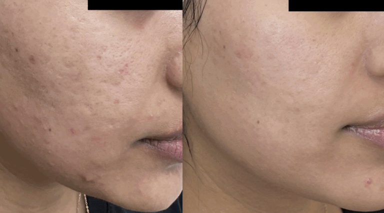 Antes y despues - Radiofrecuencia fraccionada con microagujas en CDMX