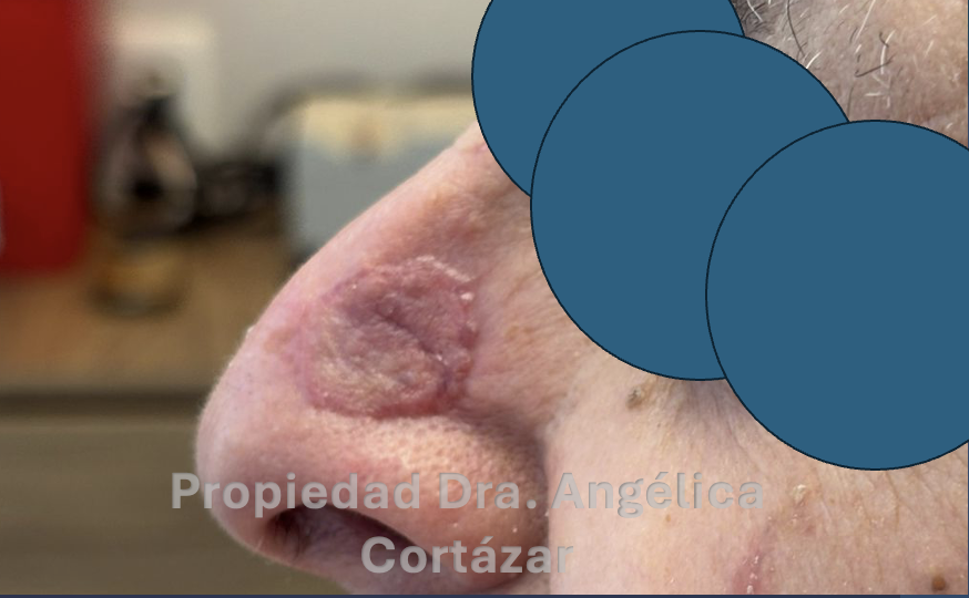 Cancer de Piel Carcinoma injerto