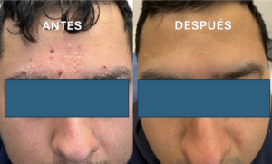 Antes y después de dermatitis seborreica facial moderada a severa.