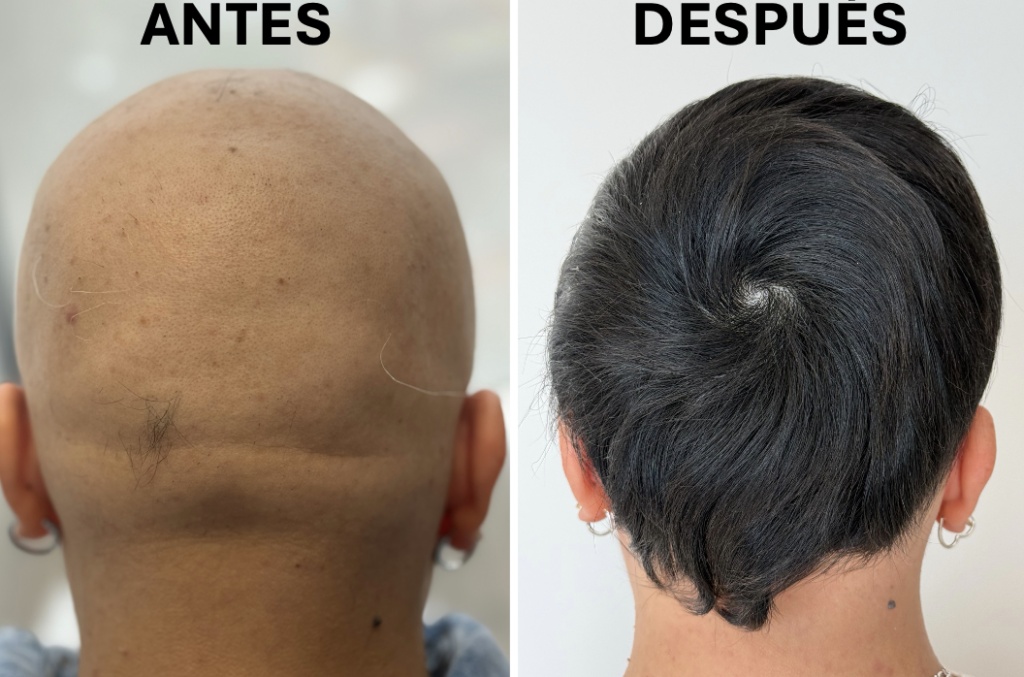 Paciente con Alopecia Areata en DermaWise CDMX - Antes y Después