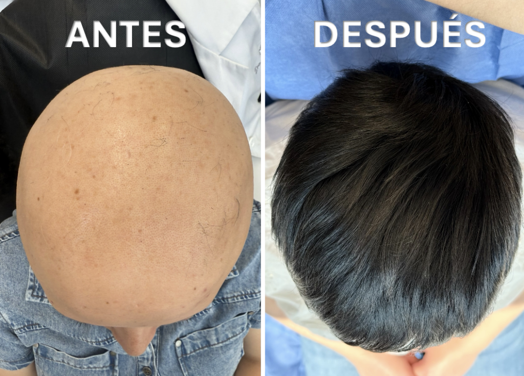 Alopécie Areata antes y después - Paciente en DermaWise CDMX