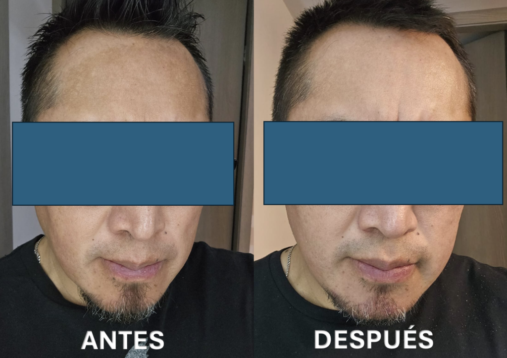 Melsasma en hombres Antes y después - DermaWise clínica dermatologica CDMX