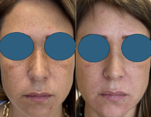 Antes y despues de Melasma en Dermawise Clínica Dermatologica CDMX