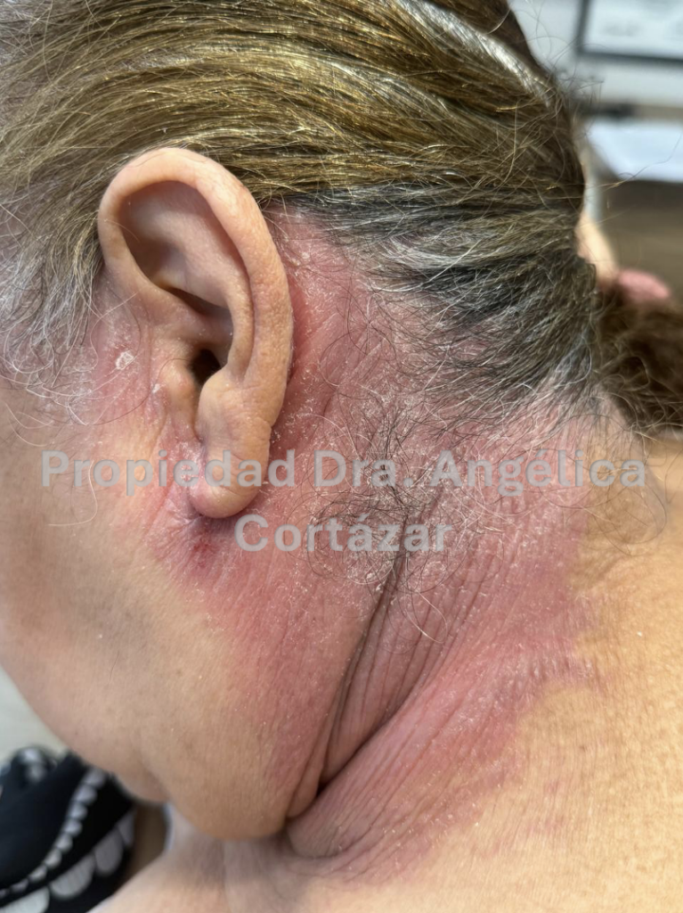 Psoriasis en el cuero cabelludo y detrás de la oreja