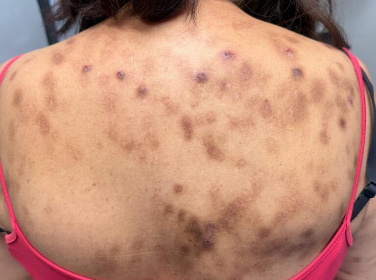 Puerto Nodular - dermatóloga - clínica dermatológica CDMX