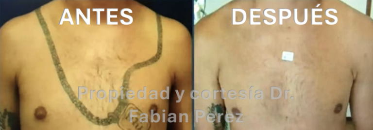 Antes y despues remoción de tatuaje